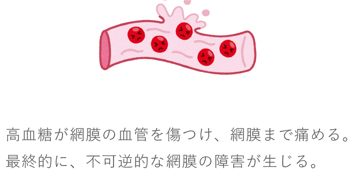 高血糖が網膜の血管を傷つけ、網膜まで痛める。最終的に、不可逆的な網膜の障害が生じる。