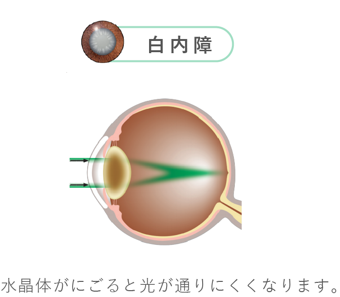 水晶体がにごると光が通りにくくなります