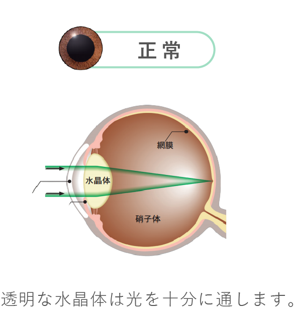 透明な水晶体は光を十分に通します